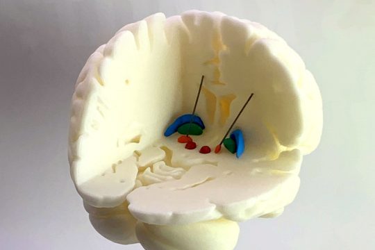 3D-Druck eines Gehirns für die Neurologie der Charité